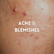 Acne & Blemishes