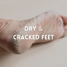 Dry And Cracky Foot