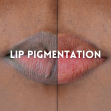 Lip Pigmentation